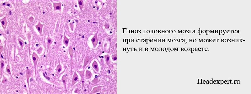 Глиоз головного мозга что это. Глиоз головного мозга гистология. Глиоз артерий головного мозга. Глиозные изменения головного мозга гистология.