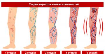 Varisli damarlı bacaklar için jimnastik