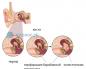 Kulak zarı ve işitme kemikçiklerinin yaralanmaları İşitsel kemikçik zincirinin yırtılması tedavisi