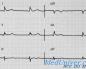 Arteriyel hipertansiyon için EKG'nin özellikleri