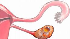 Hemoragická ovariálna cysta: príznaky, príčiny a liečba