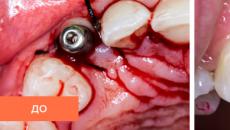 Как вставляют зубные импланты