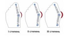 Ayak deformitesi: nasıl bir şeydir ve riski nedir?