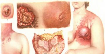 I tumori più comuni
