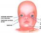خلل التعظم الفكي السفلي (متلازمة فرانشيسكيتي) عند الأطفال حديثي الولادة