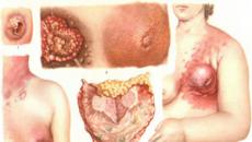 I tumori più comuni