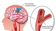 Šta je hipoksično-ishemična encefalopatija Ishemijska encefalopatija mozga
