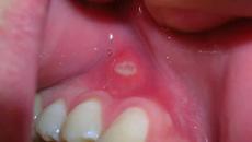 Боли венците в края на долната челюст: какво да правя?