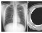 Konzultacije: pulmologija Gon lezija u plućima - što je to