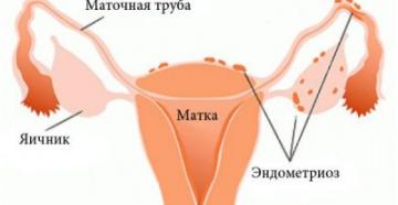 Perché il basso ventre risulta teso dopo le mestruazioni?