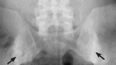 Osteosclerosis del ilion derecho tamaño 0
