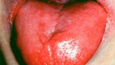 Симптоми на анемия на Адисон-Бирмер (болест) Симптоми при жени, мъже, деца